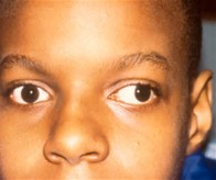 child with misaligned eyes